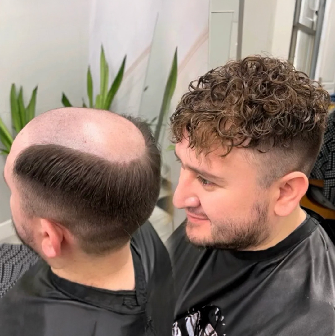 Before and after hair system transformation