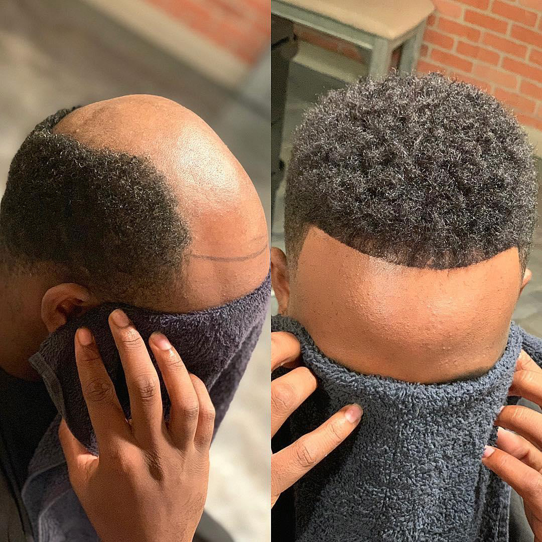 Before and after hair system transformation